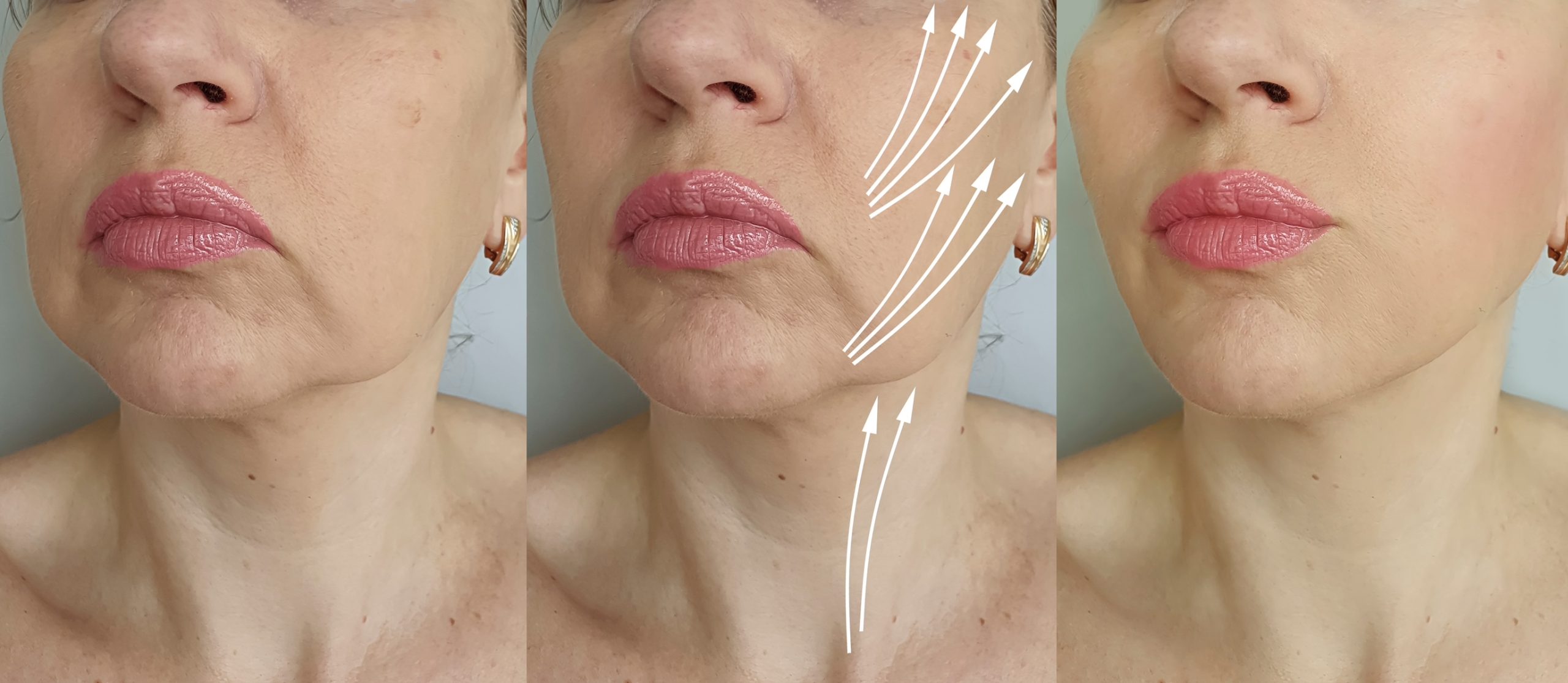 woman face wrinkles   after treatment, thread lifting