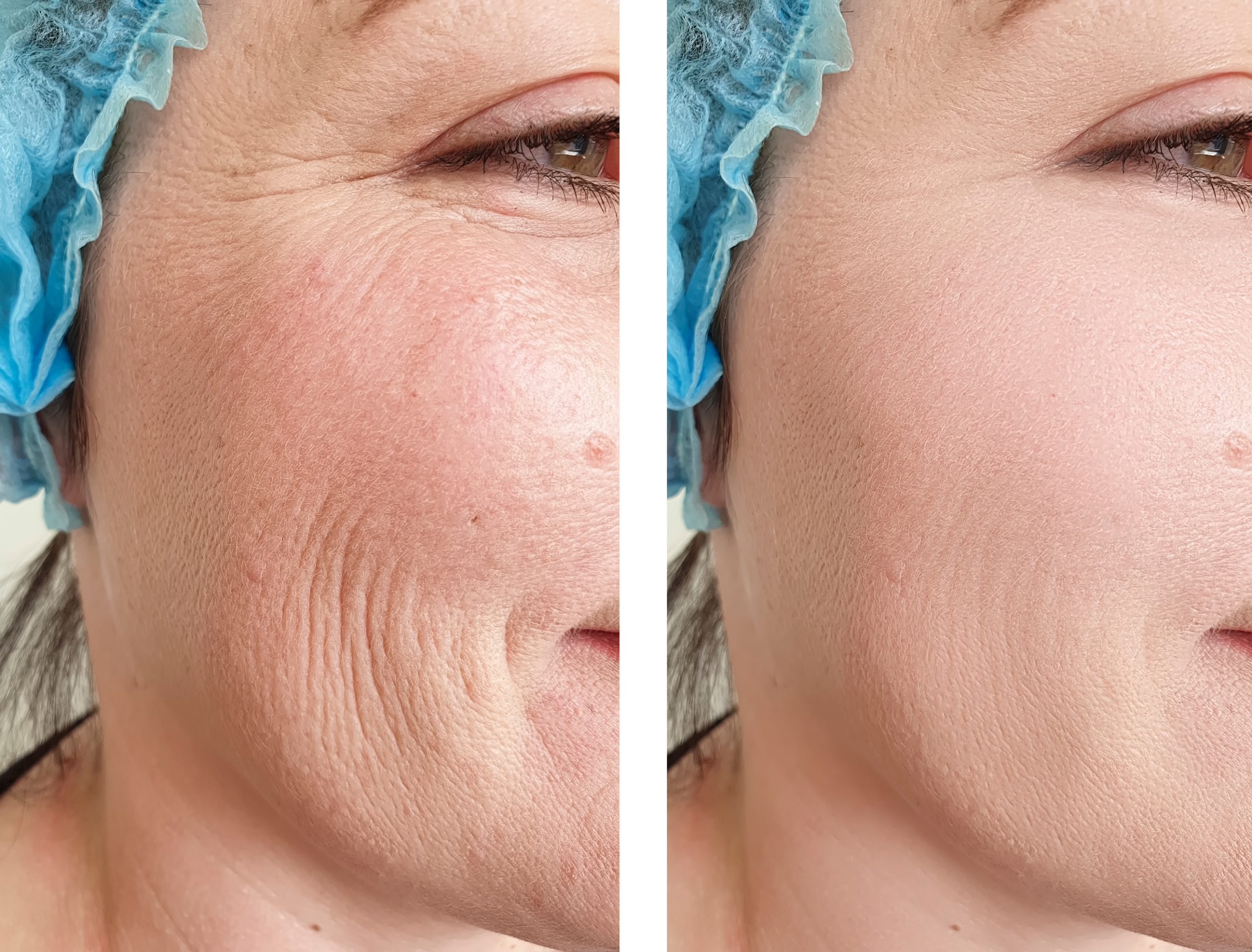 woman wrinkles face   after treatments